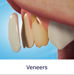 Veneers